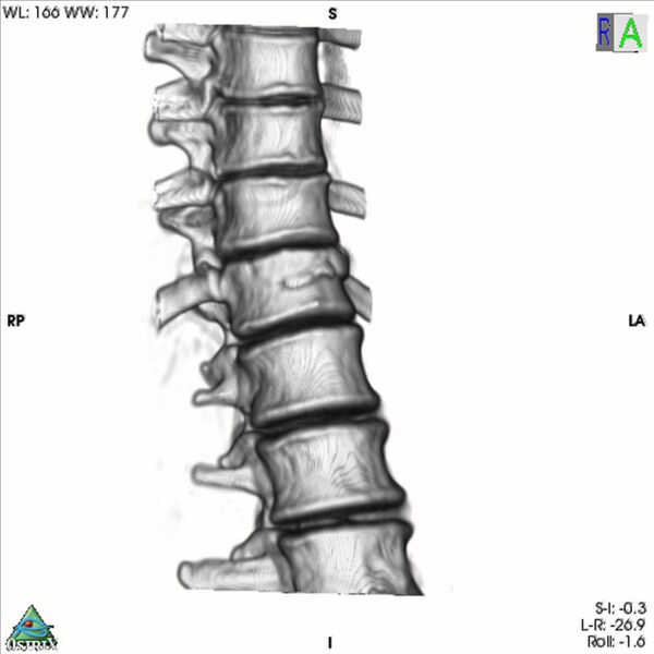 File:Bulging of paraspinal line in traumatic thoracal spinal compression fracture (Radiopaedia 29221-35872 3D VR 7).jpg