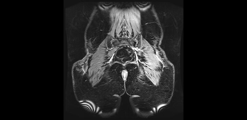 File:Buttock filler complications (Radiopaedia 63497-72115 Coronal T1 C+ 44).jpg