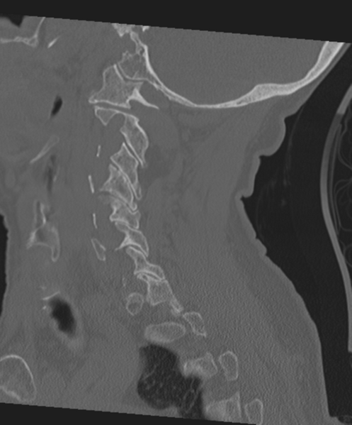 File:C2 fracture with vertebral artery dissection (Radiopaedia 37378-39199 Sagittal bone window 27).png