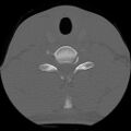 C5 facet fracture (Radiopaedia 58374-65499 Axial bone window 66).jpg