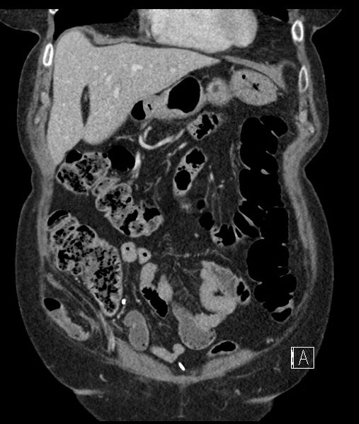 File:Calcified adrenal glands and Spigelian hernia (Radiopaedia 49741-54988 B 29).jpg