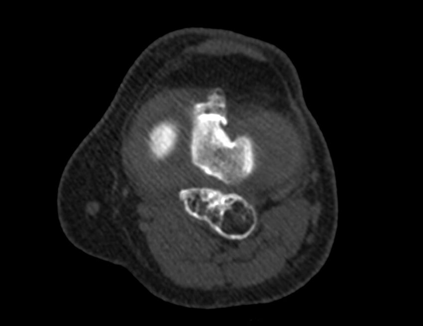 Calcified hematoma - popliteal fossa (Radiopaedia 63938-72763 Axial bone window 26).jpg