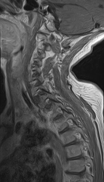 File:Calcified meningioma - cervical canal (Radiopaedia 70136-82468 Sagittal 11).jpg