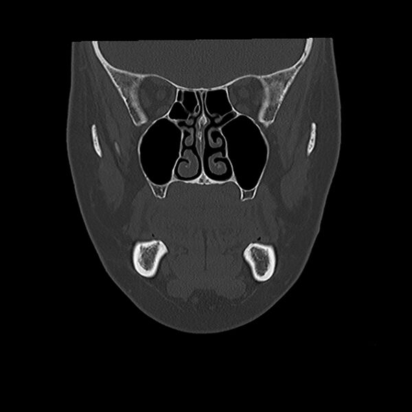 File:Canal up mastoidectomy (Radiopaedia 78108-90638 Coronal bone window 11).jpg