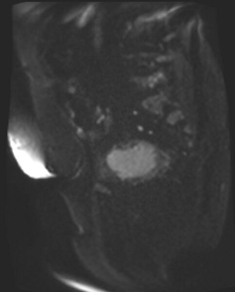 File:Cancer cervix - stage IIb (Radiopaedia 75411-86615 Sagittal DWI 65).jpg