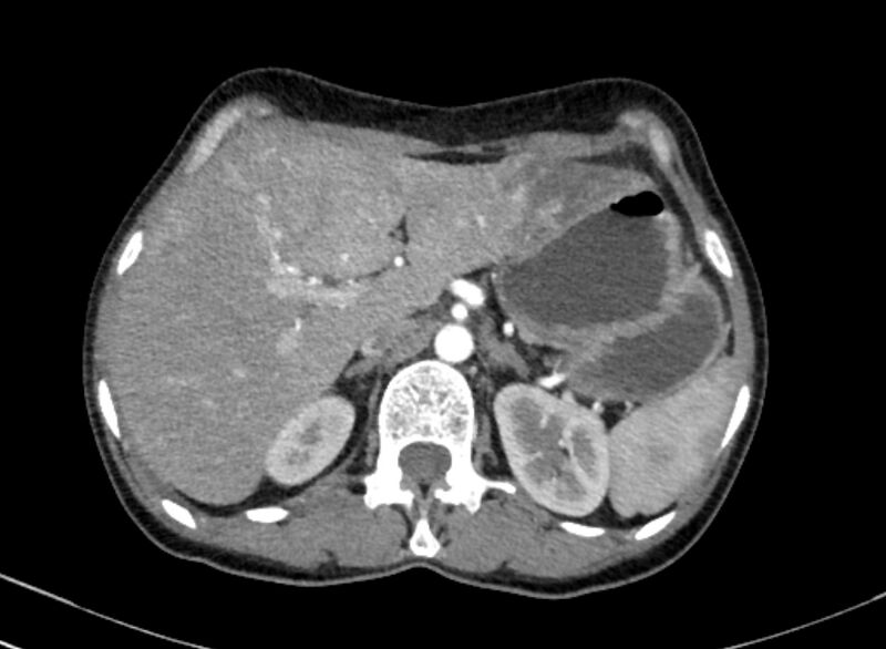 File:Cannonball metastases from breast cancer (Radiopaedia 91024-108569 A 121).jpg