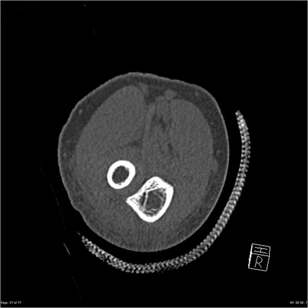 File:Capitellum fracture (Radiopaedia 23352-23426 Coronal bone window 57).jpg