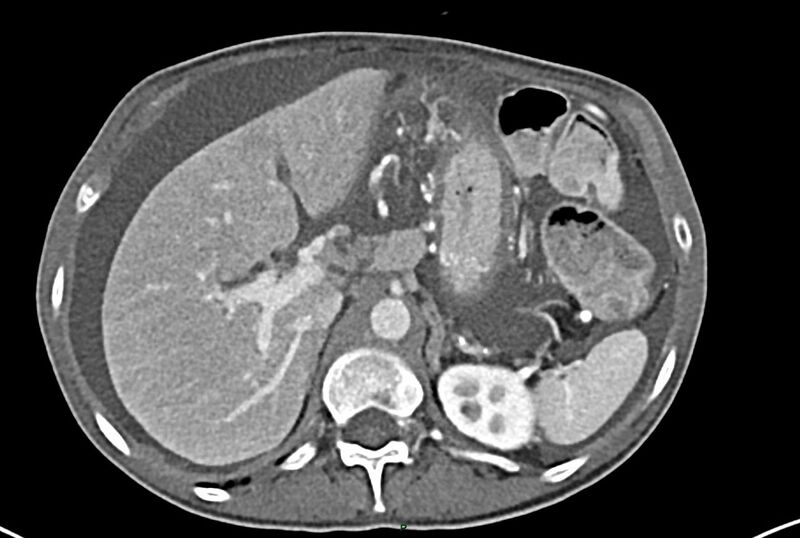File:Carcinoid mesenteric tumor complicated by chylous ascites (Radiopaedia 76312-87953 A 18).jpg