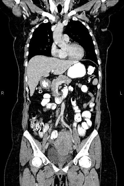 File:Carcinoma of uterine cervix (Radiopaedia 85861-101700 C 21).jpg