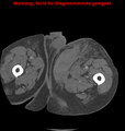 Cardiac perforation following transcatheter aortic valve implantation (Radiopaedia 23714-23863 B 32).png