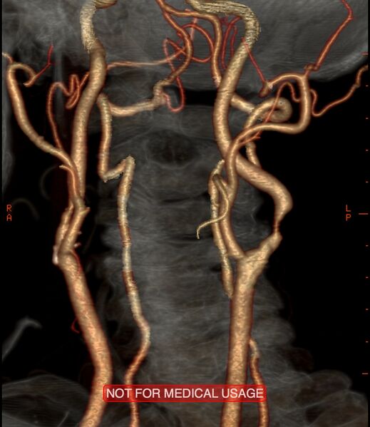 File:Carotid artery stenosis (Radiopaedia 28786-29086 A 3).jpg