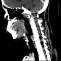 Carotid body tumor (Radiopaedia 27890-28124 C 10).jpg