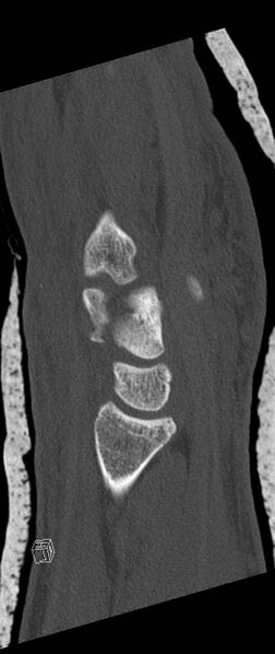 File:Carpal fractures (smart watch impaction) (Radiopaedia 55844-62430 Sagittal bone window 17).jpg
