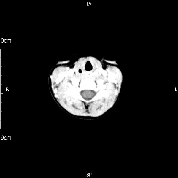 File:Cavernous sinus thrombosis (Radiopaedia 79414-92510 Axial Brain 2).jpg