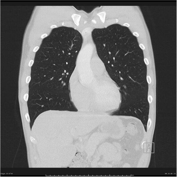 File:Cavitating lung cancer (Radiopaedia 25796-25945 lung window 13).jpg