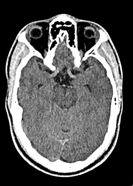 File:Cavum septum pellucidum and cavum vergae (Radiopaedia 77797-90060 Axial Brain Window 39).jpg