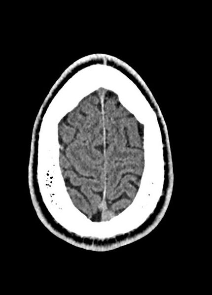 File:Cavum septum pellucidum and cavum vergae (Radiopaedia 77797-90060 Axial Brain Window 92).jpg