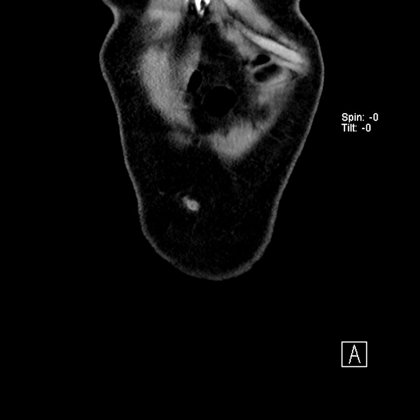 Cecal volvulus (Radiopaedia 90897-108397 Coronal non-contrast 57).jpg