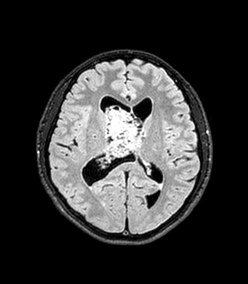 Central neurocytoma (Radiopaedia 79320-92380 Axial FLAIR 144).jpg