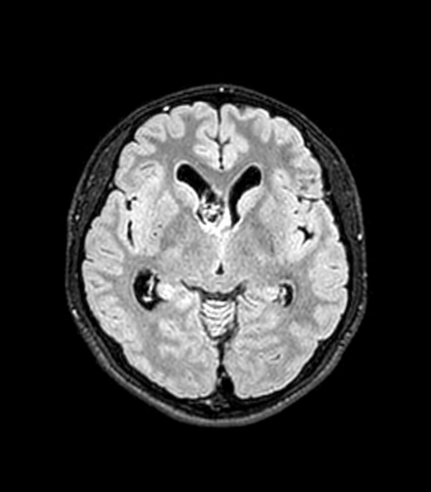 Central neurocytoma (Radiopaedia 79320-92380 Axial FLAIR 172).jpg
