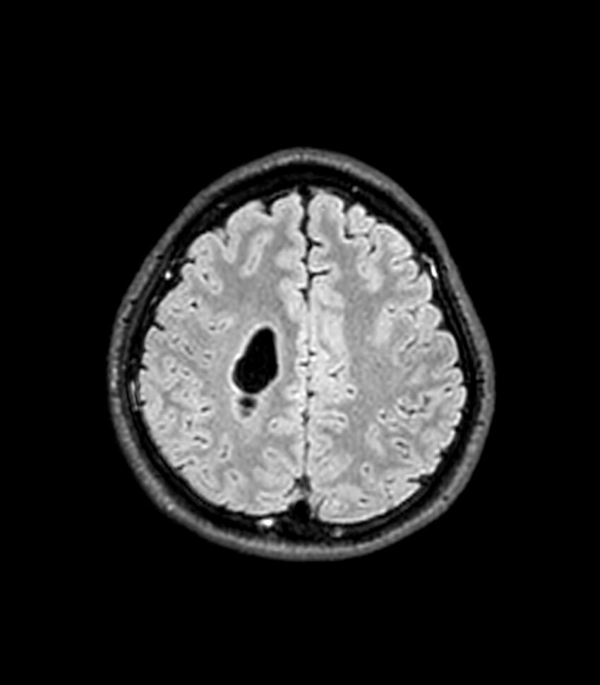 Central neurocytoma (Radiopaedia 79320-92380 Axial FLAIR 89).jpg