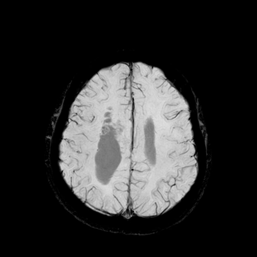 Central neurocytoma (Radiopaedia 79320-92380 Axial SWI 104).jpg