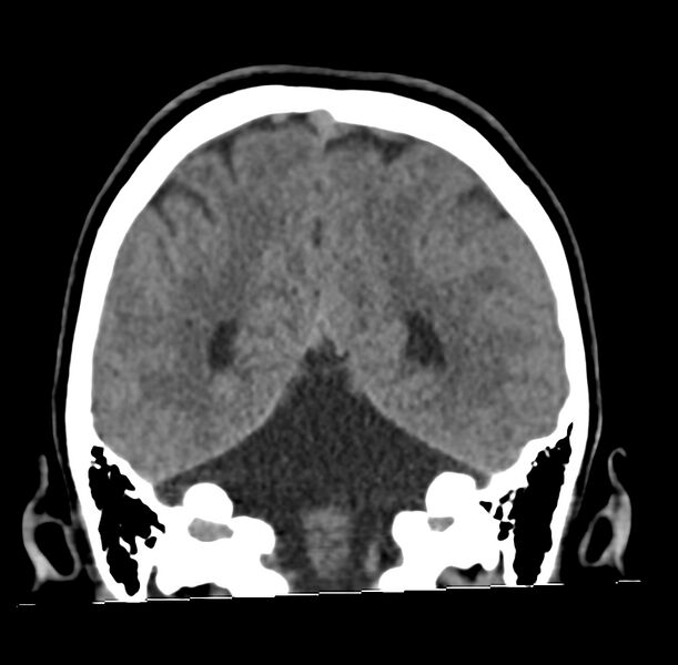 File:Cerebellar agenesis (Radiopaedia 30203-30817 Coronal non-contrast 32).jpg