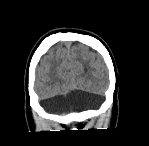 File:Cerebellar agenesis (Radiopaedia 30203-30817 Coronal non-contrast 43).jpg