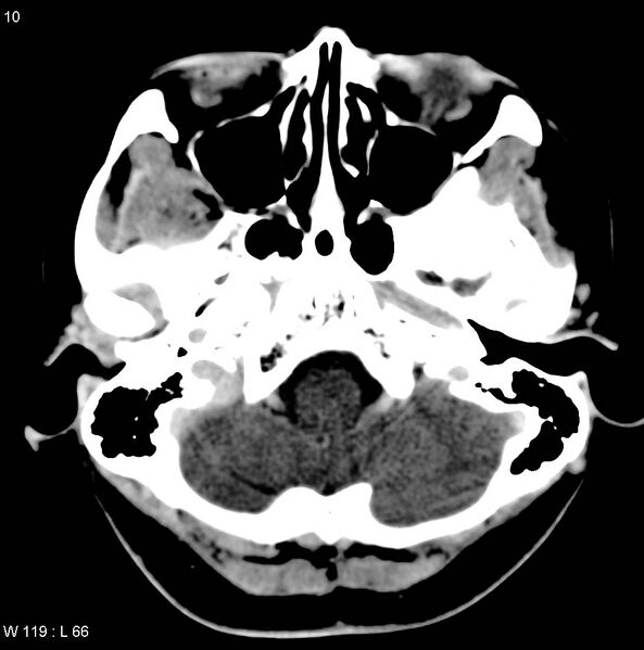 File:Cerebellar arteriovenous malformation (Radiopaedia 5220-36607 A 1).jpg