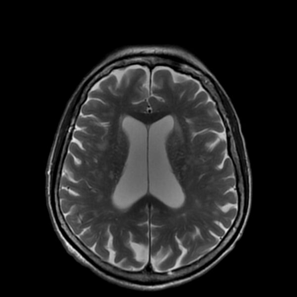 File:Cerebellar ataxia with neuropathy and vestibular areflexia syndrome (CANVAS) (Radiopaedia 74283-85159 Axial T2 14).jpg
