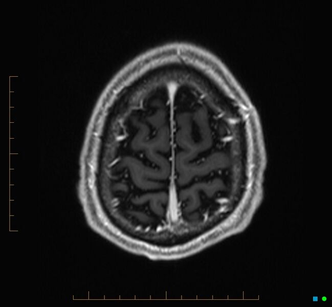 File:Cerebellar gangliocytoma (Radiopaedia 65377-74422 Axial T1 C+ 130).jpg