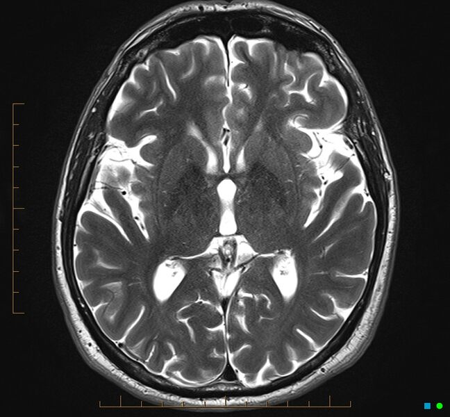 File:Cerebellar gangliocytoma (Radiopaedia 65377-74422 Axial T2 19).jpg