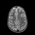 Cerebral abscess post cardiac surgery (Radiopaedia 27244-27420 Axial T2 18).jpg