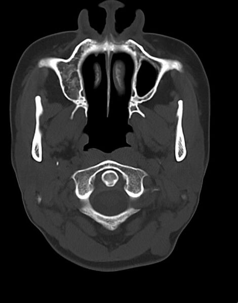 File:Cerebral abscesses (Radiopaedia 70458-80568 Axial bone window 8).jpg