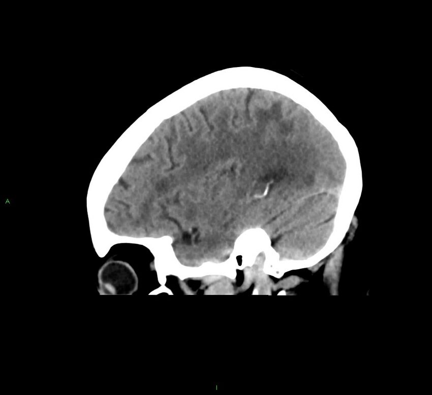 Cerebral amyloid angiopathy-associated lobar intracerebral hemorrhage (Radiopaedia 58378-65516 C 37).jpg