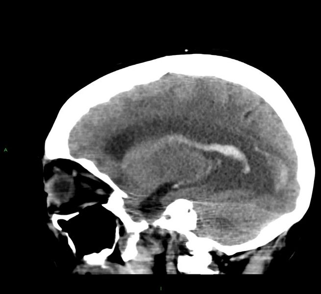 File:Cerebral amyloid angiopathy-associated lobar intracerebral hemorrhage (Radiopaedia 58379-65519 C 36).jpg