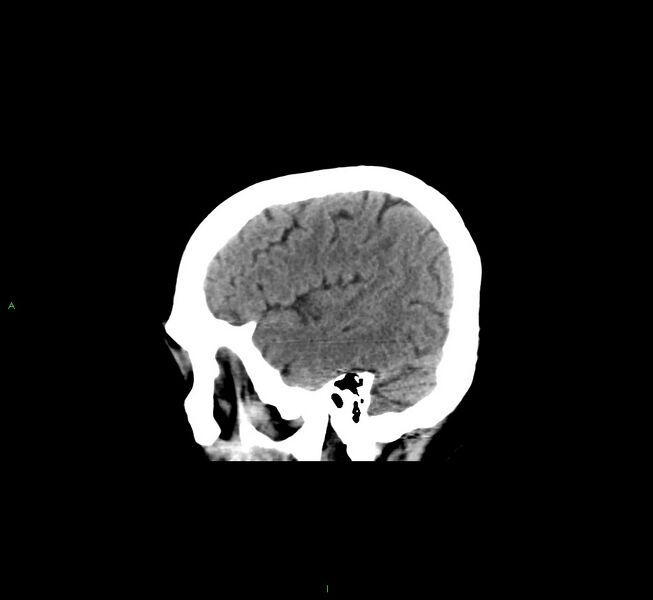 File:Cerebral amyloid angiopathy-associated lobar intracerebral hemorrhage (Radiopaedia 58529-65681 B 10).jpg
