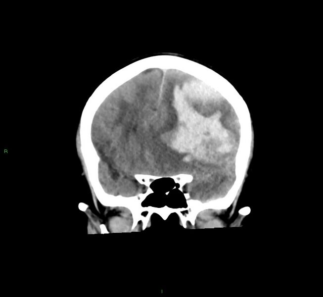 File:Cerebral amyloid angiopathy-associated lobar intracerebral hemorrhage (Radiopaedia 58561-65724 Coronal non-contrast 41).jpg