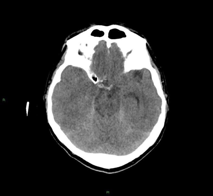 Cerebral amyloid angiopathy-associated lobar intracerebral hemorrhage (Radiopaedia 58756-65977 Axial non-contrast 34).jpg