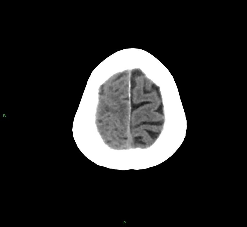 Cerebral amyloid angiopathy-associated lobar intracerebral hemorrhage (Radiopaedia 58758-65980 Axial non-contrast 7).jpg