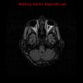 Cerebral and orbital tuberculomas (Radiopaedia 13308-13311 Axial FLAIR 5).jpg
