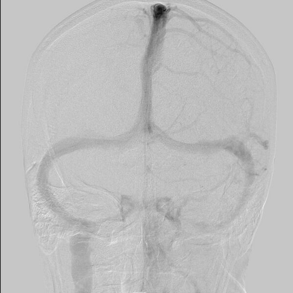 File:Cerebral aneurysm with rupture (Radiopaedia 29933-30458 LT CCA IC 23).jpg