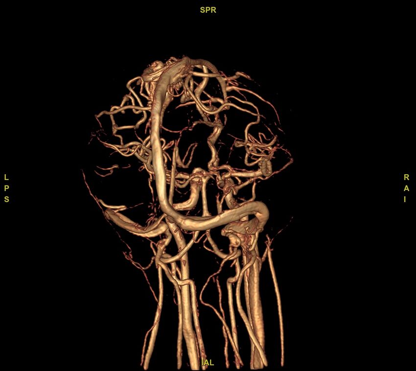 Cerebral arteriovenous malformation (Radiopaedia 61964-70029 VRT 18).jpg