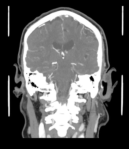 File:Cerebral dural venous sinus thrombosis (Radiopaedia 86514-102576 B 42).jpg