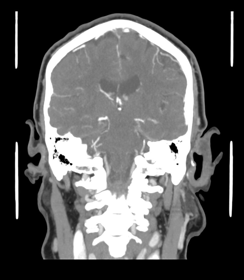 Cerebral dural venous sinus thrombosis (Radiopaedia 86514-102576 B 42).jpg