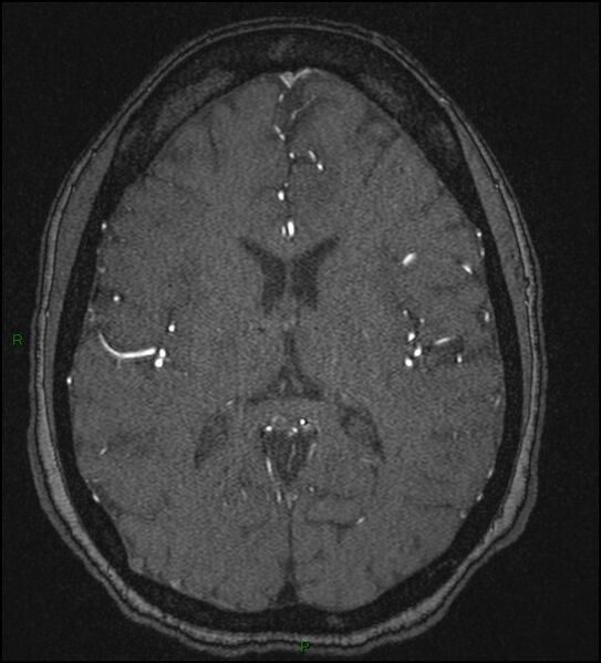 File:Cerebral fat embolism (Radiopaedia 35022-36525 Axial TOF 119).jpg