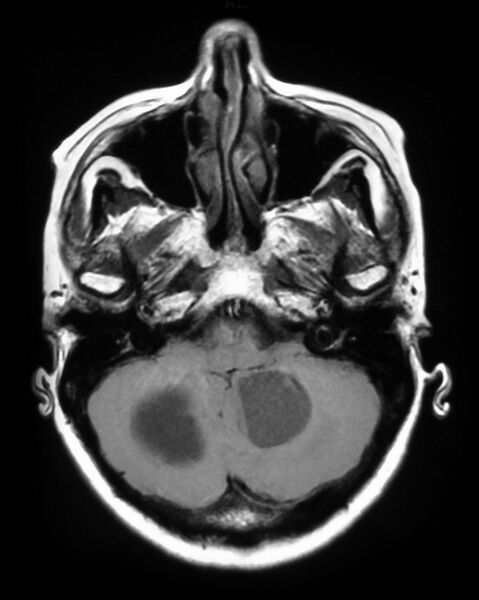 File:Cerebral metastases - small cell lung cancer (Radiopaedia 3972-6521 Axial T1 1).jpg