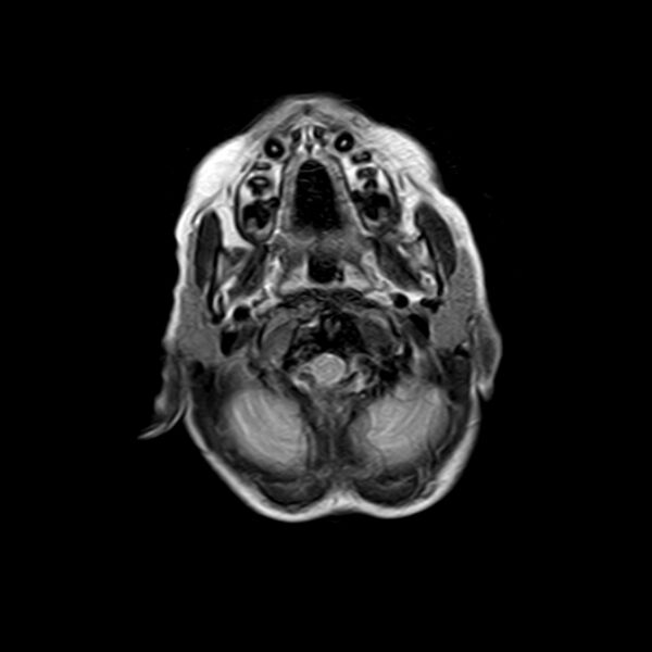 File:Cerebral tuberculoma (Radiopaedia 41152-43932 Axial T2 1).jpg