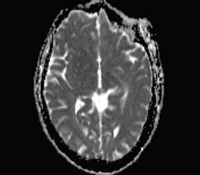 File:Cerebral venous thrombosis (Radiopaedia 71207-81504 Axial ADC 9).jpg