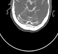 Cervical dural CSF leak on MRI and CT treated by blood patch (Radiopaedia 49748-54996 B 1).png